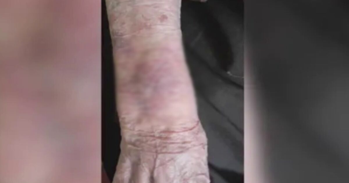 След като 104-годишна жена беше изписана със синини от видинската