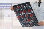 Животоспасяваща терапия за исхемичен инсулт е вече достъпна в България