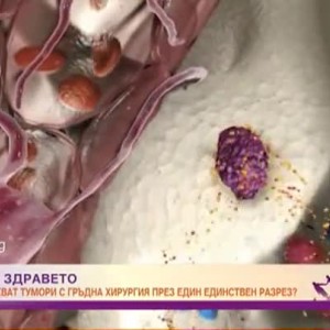 Снимка: Как се премахват тумори с гръдна хирургия през един-единствен разрез?