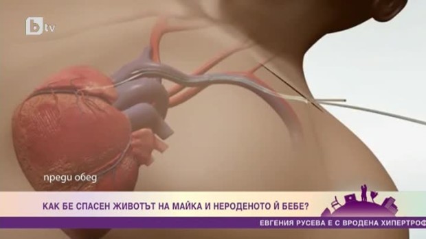 Снимка: Как чрез революционна кардиологична операция в София бе спасен животът на една бременна...
