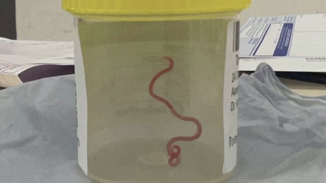 Жив червей беше открит в мозъка на жена в Австралия