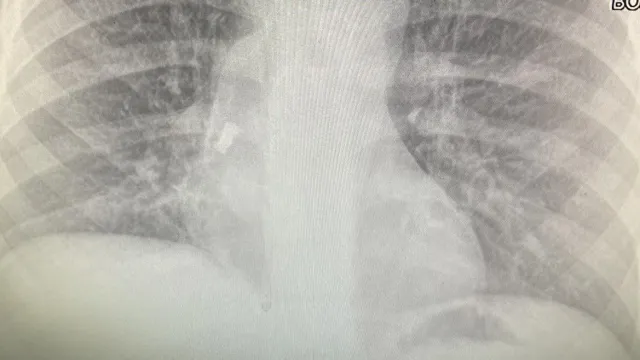 Лекари спасиха петокласник в Бургас след като млечен зъб заседна