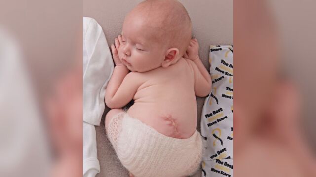 Бебе оцелява след невероятна операция Лекарите оперирали гръбначния му стълб