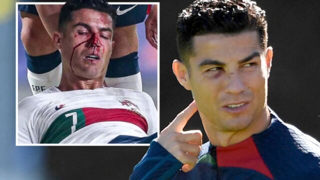 Юнак с рана: Роналдо показа пораженията по лицето си