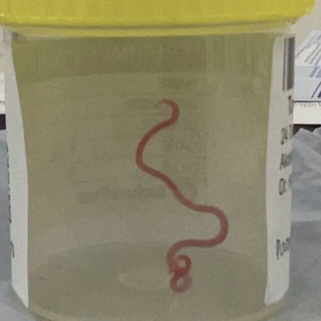 „8-сантиметров и се гърчеше“: Лекари откриха жив червей в мозъка на жена