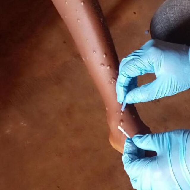  Маймунската шарка – новият COVID-19 ли е и какъв брой е рискова? 