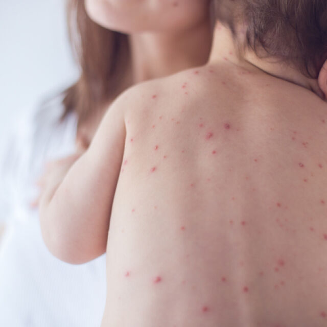 Епидемия от морбили: Родителите да спазват имунизационния календар