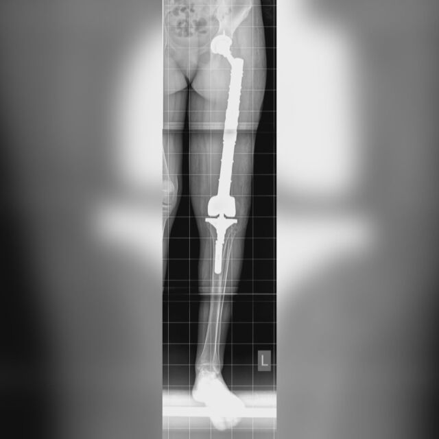 Медицински успех: Как лекари замениха обхваната от тумор бедрена кост с протеза?