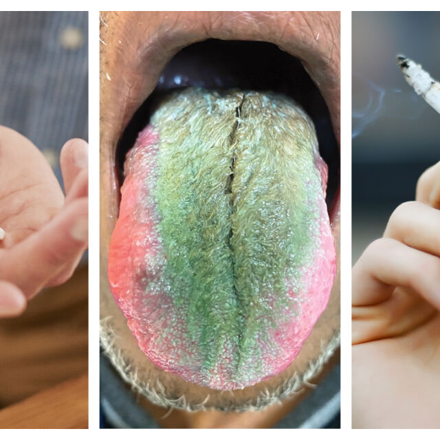 Зелен космат език – какво се случи на мъж, който пуши и приема антибиотици