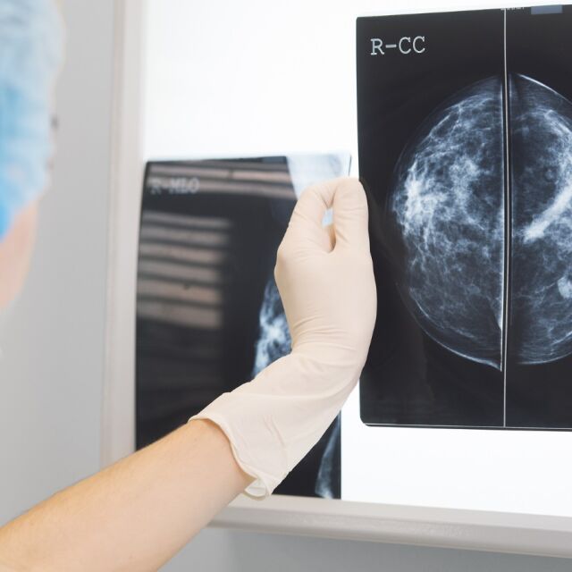 Американски специалисти излекуваха рак на гърдата с имунотерапия