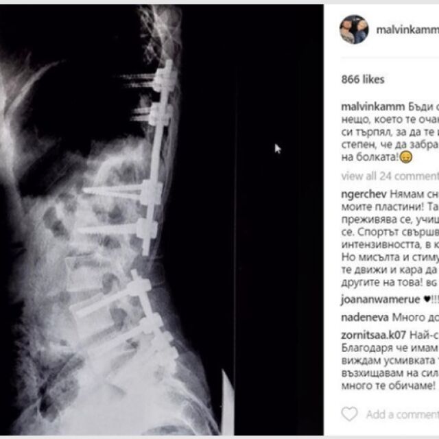 Цветелина Стоянова показа рентгенова снимка на гръбнака си