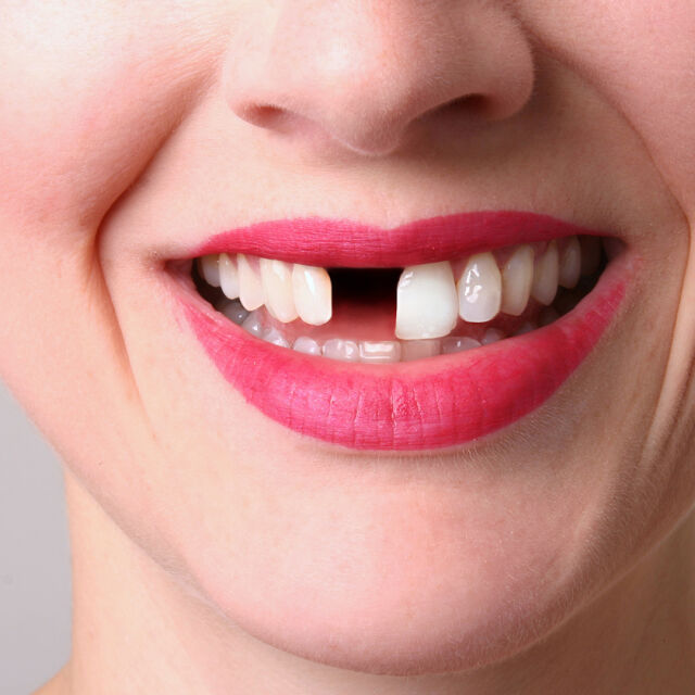 Майките с повече деца имат по-малко зъби по-късно през живота си