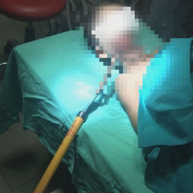 Уникална операция в Бургас: Лекари извадиха от главата на момче градинска ножица