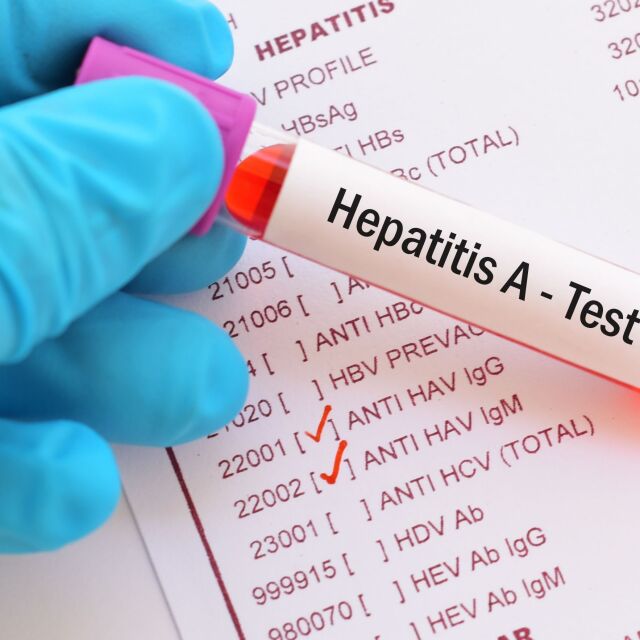Броят на заразени от Хепатит А в София расте