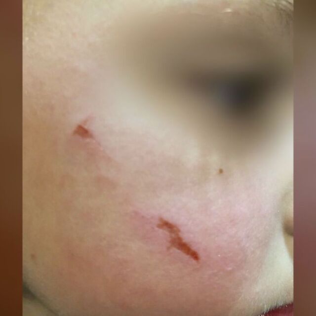 Дете пострада в детска градина, нападнато от свой връстник