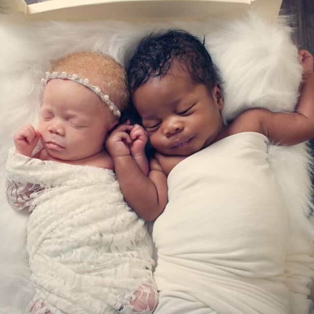 Качи и Камси – близнаците, които се раждат с различен цвят на кожата, очите и косата