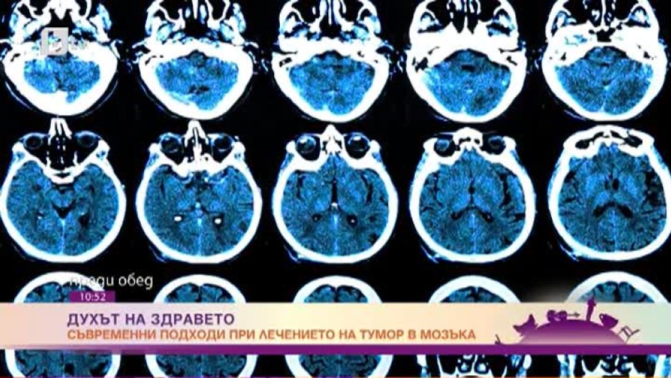 Съвременни подходи при лечението на тумор в мозъка