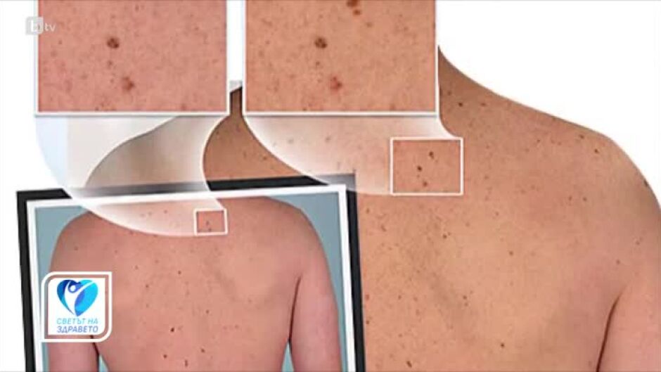 Нови методи за диагностика и контрол на рака на кожата