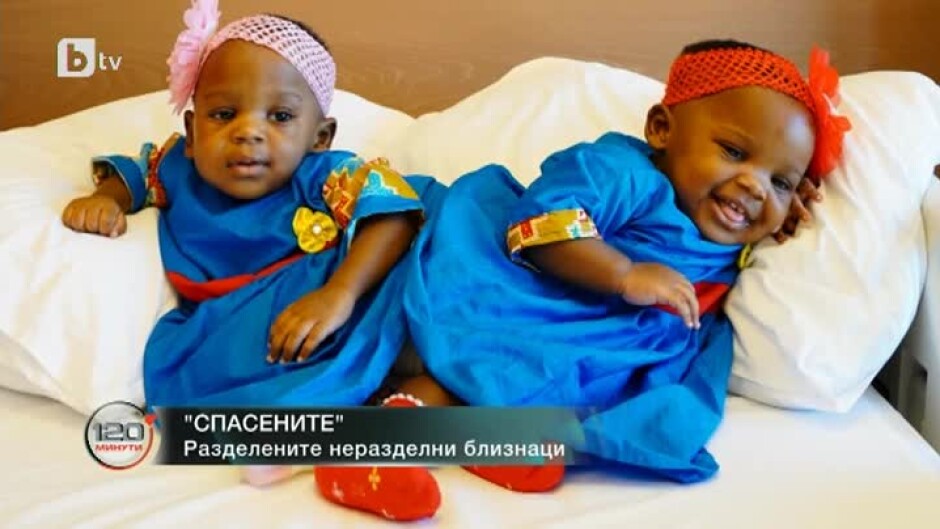 "Спасените": Сиамски близнаци бяха успешно разделени