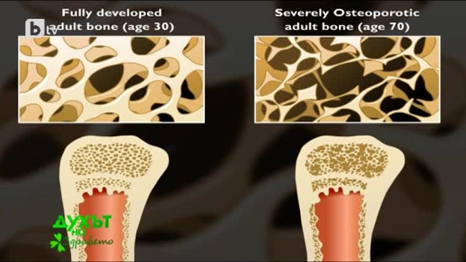 Причините, превенцията и лечението на остеопорозата