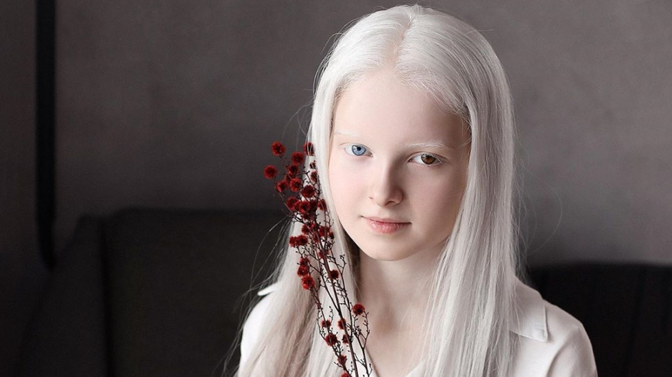 Амина Апендиева – чеченското момиче, което дължи красотата си на две редки генетични състояния