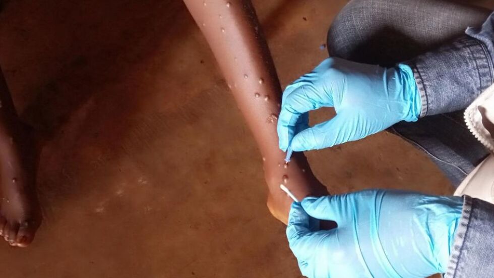  Маймунската шарка – новият COVID-19 ли е и какъв брой е рискова? 