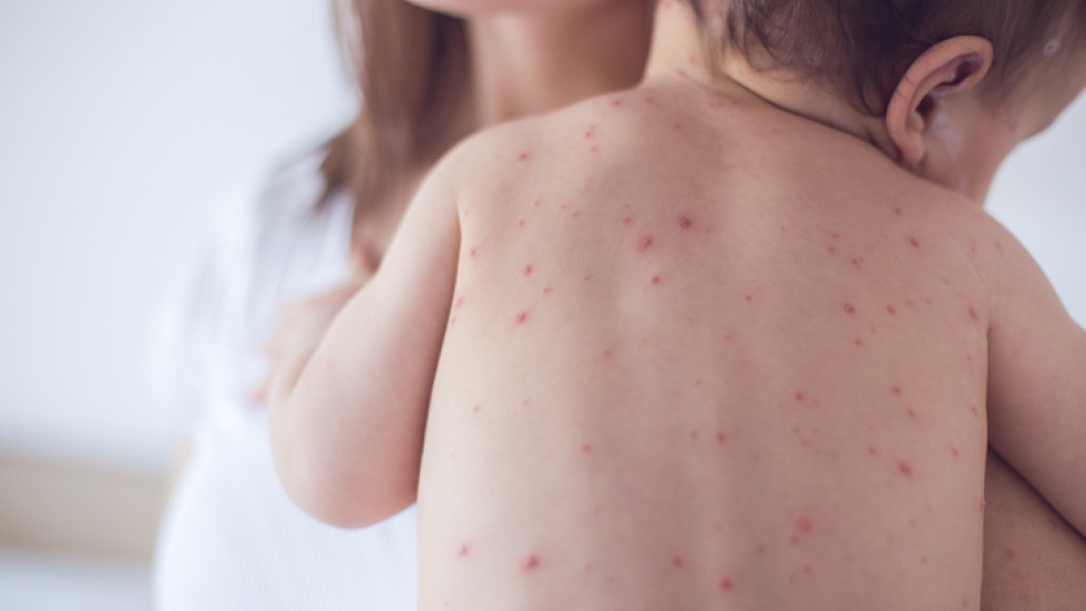Епидемия от морбили: Родителите да спазват имунизационния календар