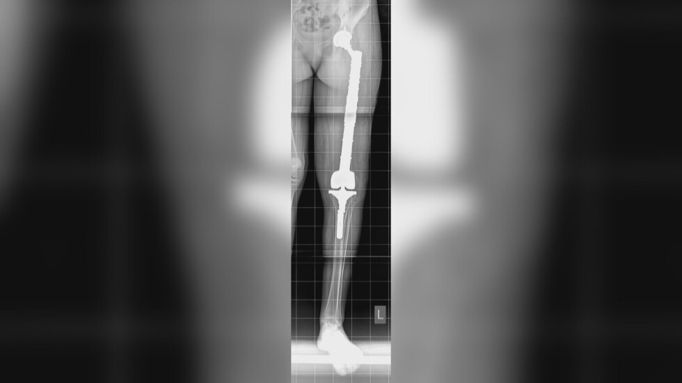 Медицински успех: Как лекари замениха обхваната от тумор бедрена кост с протеза?