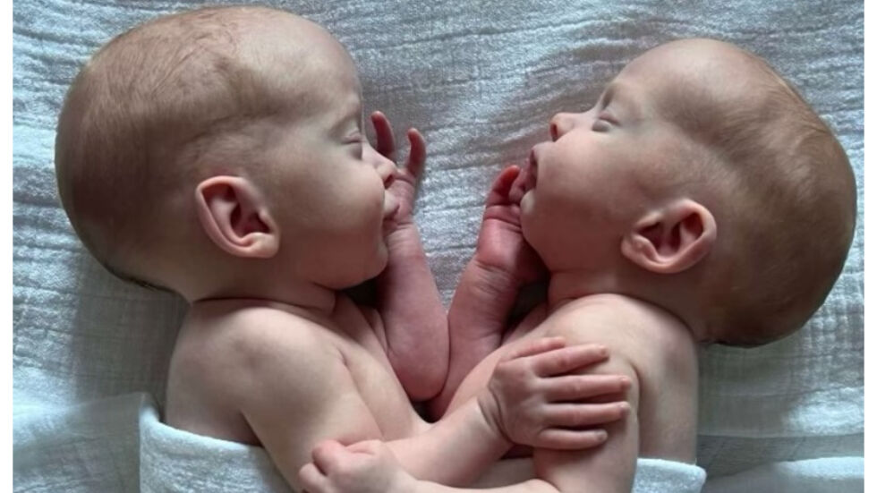 „Благодарни сме!“ Сиамски близначки бяха разделени след 4-часова рискова операция