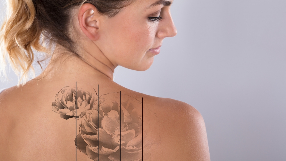 5 неща, които трябва да знаем за премахването на татуировките
