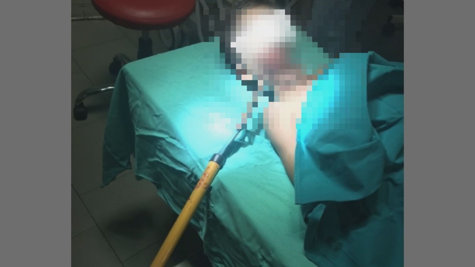 Уникална операция в Бургас: Лекари извадиха от главата на момче градинска ножица