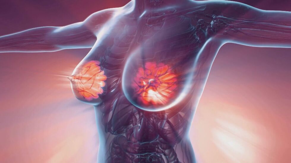 Над 4000 българки се разболяват от рак на гърдата всяка година