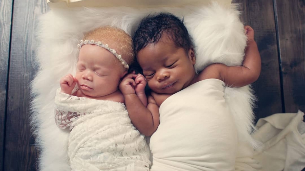 Качи и Камси – близнаците, които се раждат с различен цвят на кожата, очите и косата